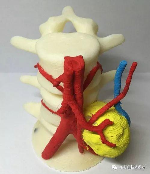 3D打印如何辅助医生手术，如何宽慰患者