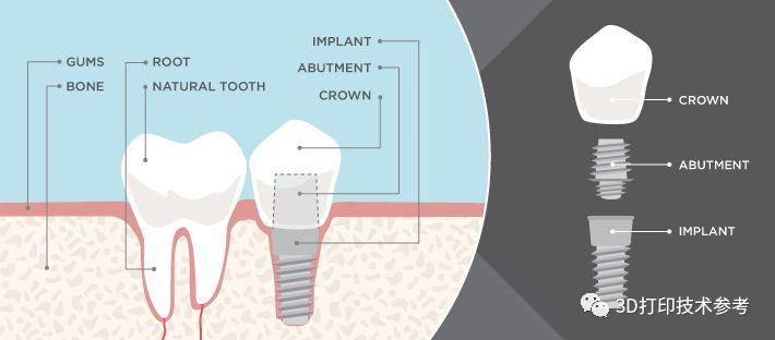 3D打印在口腔种植领域的应用效果如何？