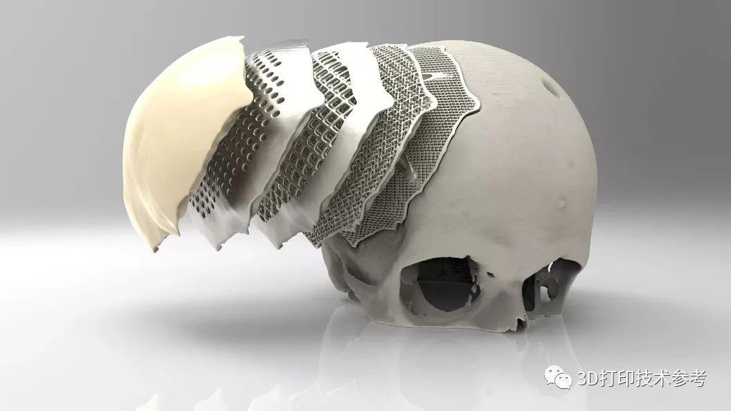 钛合金和PEEK颅骨修复体的传统和3D打印制造方式及面临的问题