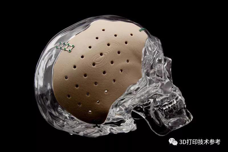 钛合金和PEEK颅骨修复体的传统和3D打印制造方式及面临的问题