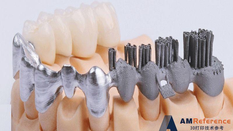 3D打印医疗植入物的应用现状及国内研究团体