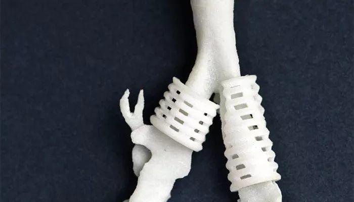 医疗案例：3D打印气管支架用于复杂手术