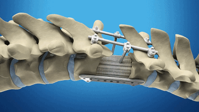 推荐视频：3D打印如何助力修复脊椎损伤（画面唯美）