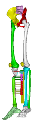 3D扫描+3D打印，重点分析骨科微创精准矫正手术“私人定制”案例