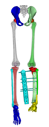 3D扫描+3D打印，重点分析骨科微创精准矫正手术“私人定制”案例