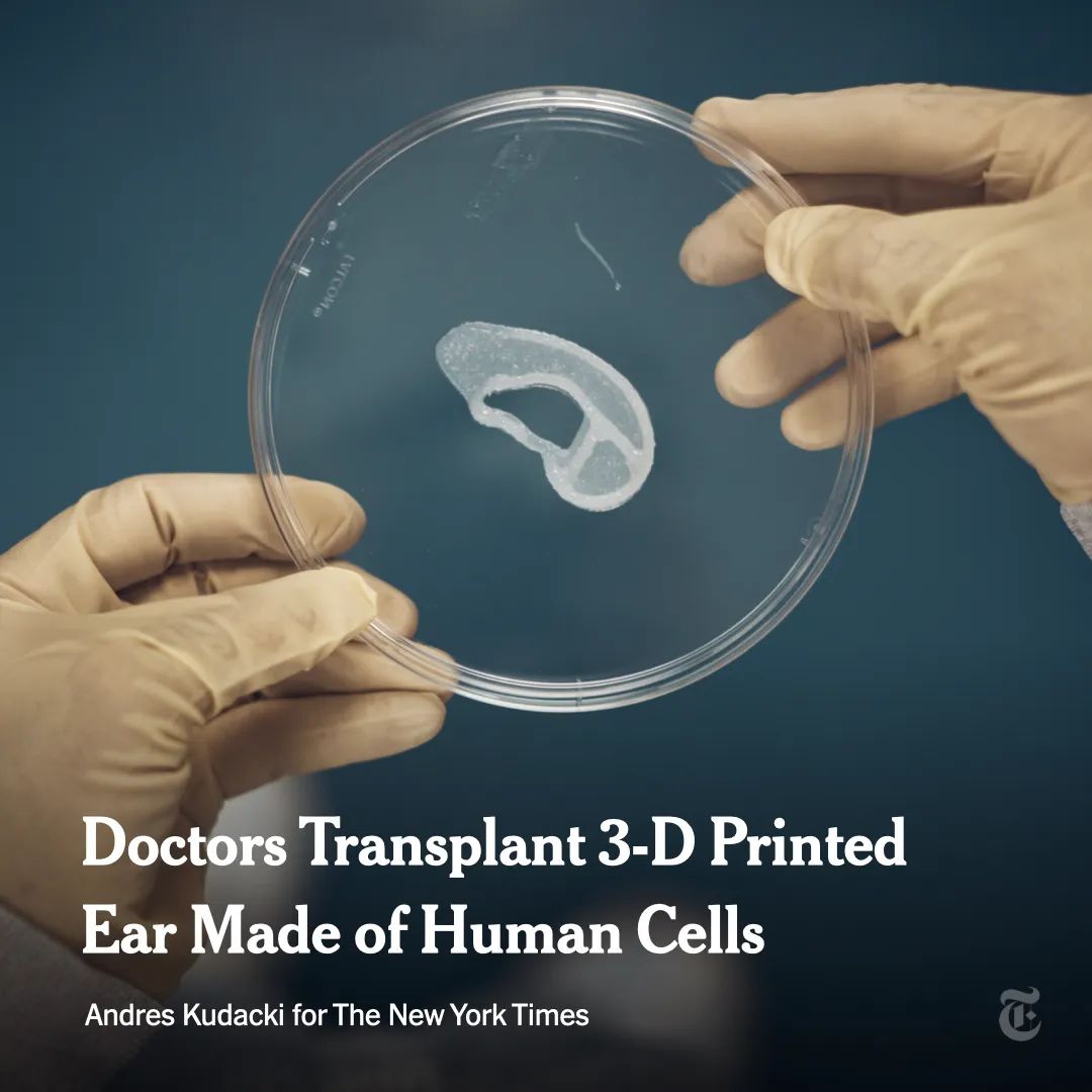 用自体细胞培养的3D打印耳朵首次完成移植