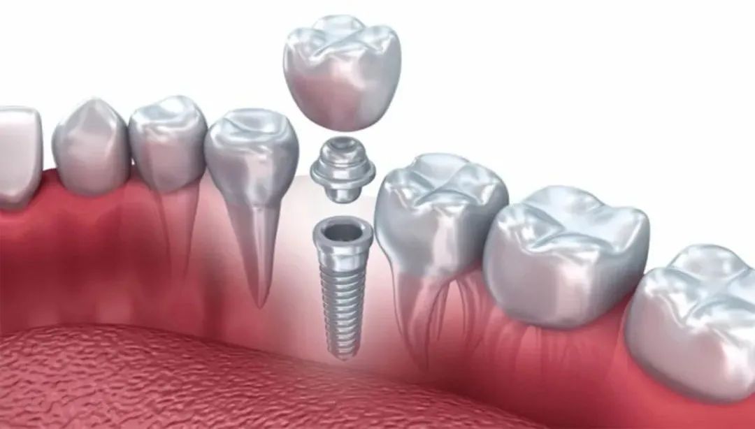 国家医保局：全面开展种植牙价格调查，为集采奠定基础，3D打印治疗齿科有优势