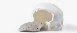 孟加拉国专科医院购买中国3D打印机开展PEEK颅骨植入手术